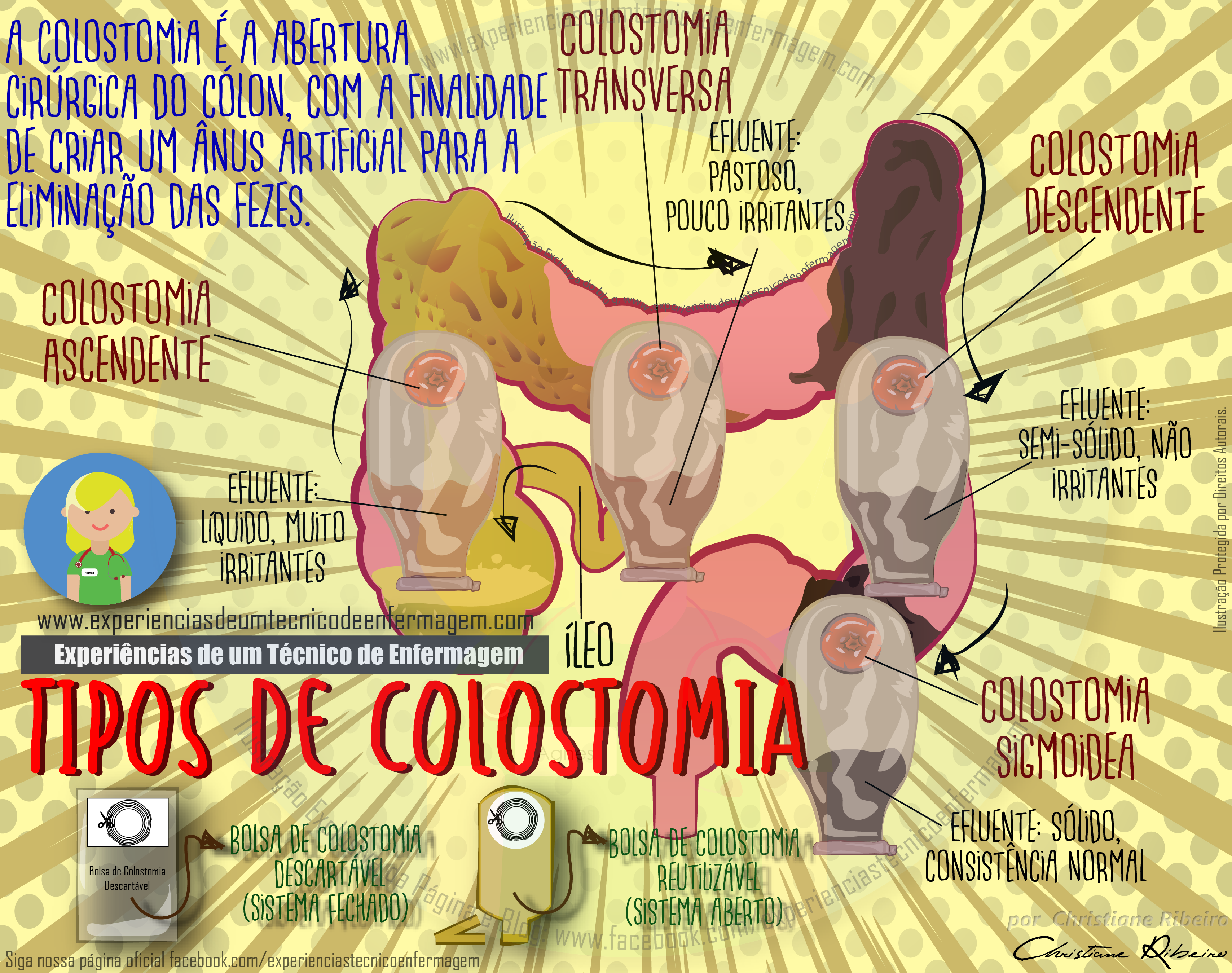Colostomia: O que é?