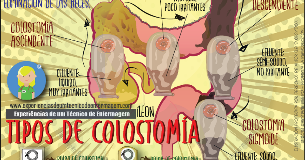 Colostomía: ¿Qué es?