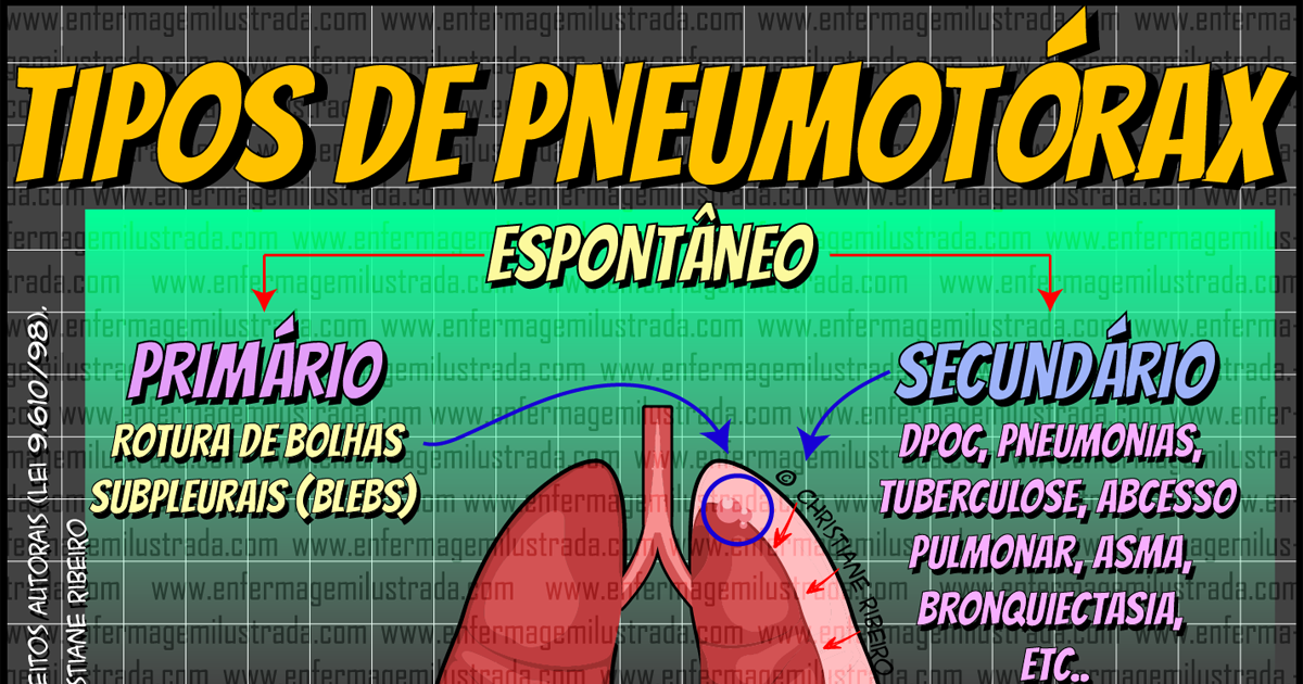 Pneumotórax: Entenda os Tipos, Diferenças e Cuidados de Enfermagem ...