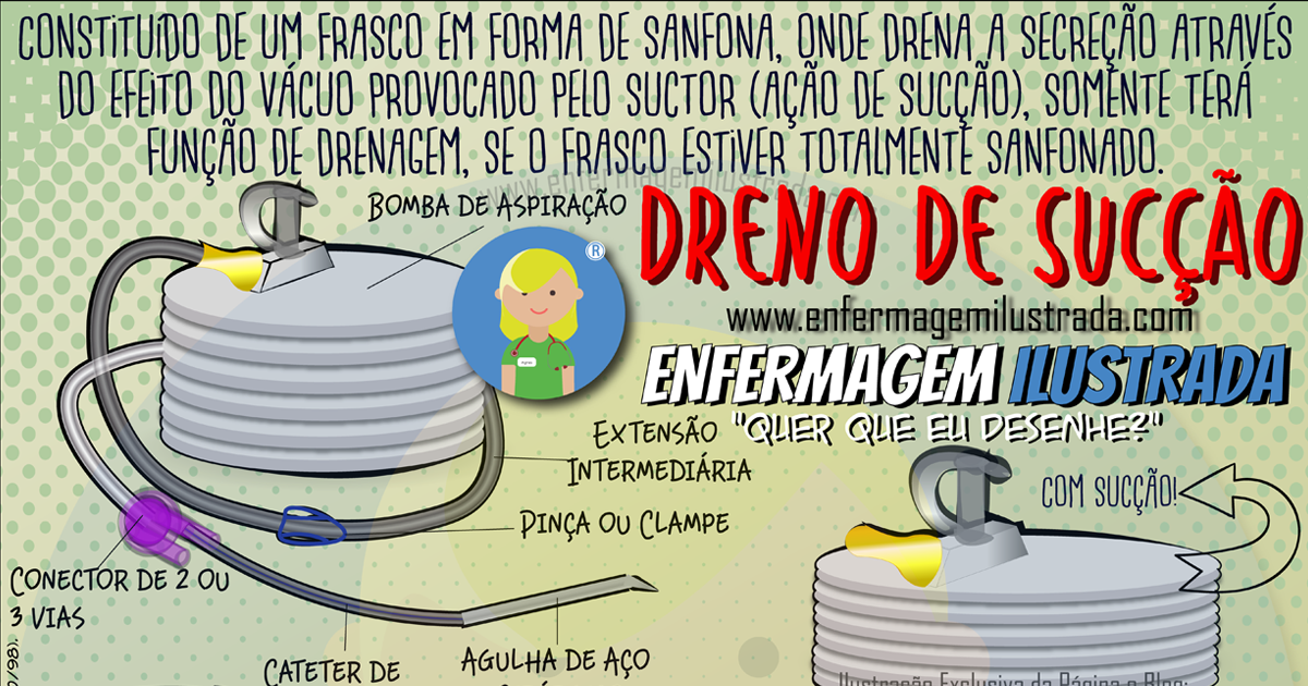 Dreno de Sucção Sistema Fechado - Enfermagem Ilustrada